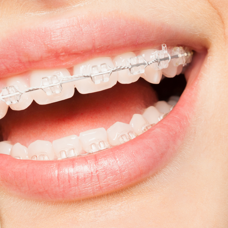 How to Floss with Braces: A Step-by-Step Guide That Actually Works